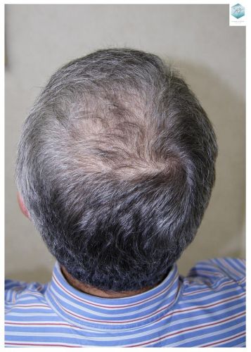 Injerto Capilar Técnica FUE 2911 Grafts (Pelos 6191) 14 trasplante pelo canoso