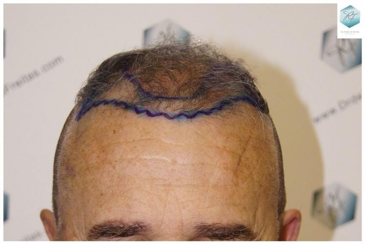 Injerto Capilar Técnica FUE 2911 Grafts (Pelos 6191) 6 diseño linea injerto capilar