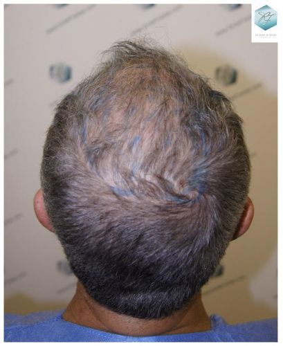 Injerto Capilar Técnica FUE 2911 Grafts (Pelos 6191) 13 trasplante pelo canoso
