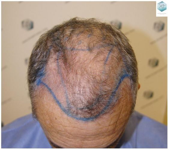 Injerto Capilar Técnica FUE 2911 Grafts (Pelos 6191) 7 trasplante pelo canoso