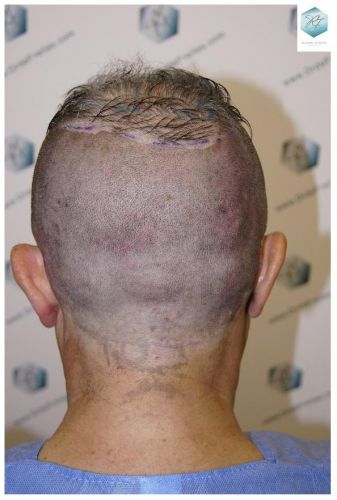 Injerto Capilar Técnica FUE 2911 Grafts (Pelos 6191) 12 trasplante pelo canoso