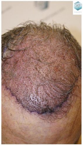 Injerto Capilar Técnica FUE 2911 Grafts (Pelos 6191) 8 trasplante pelo canoso