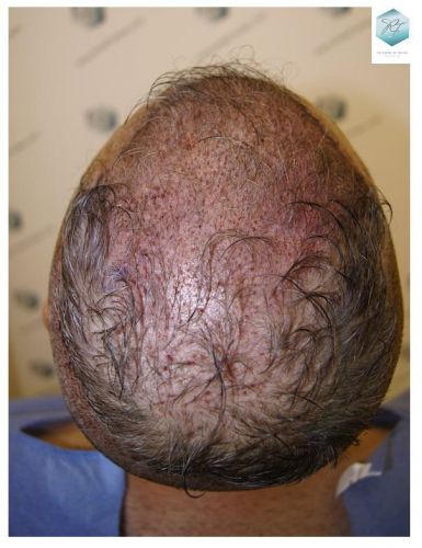 Injerto Capilar Técnica FUE 2911 Grafts (Pelos 6191) 11 trasplante pelo canoso