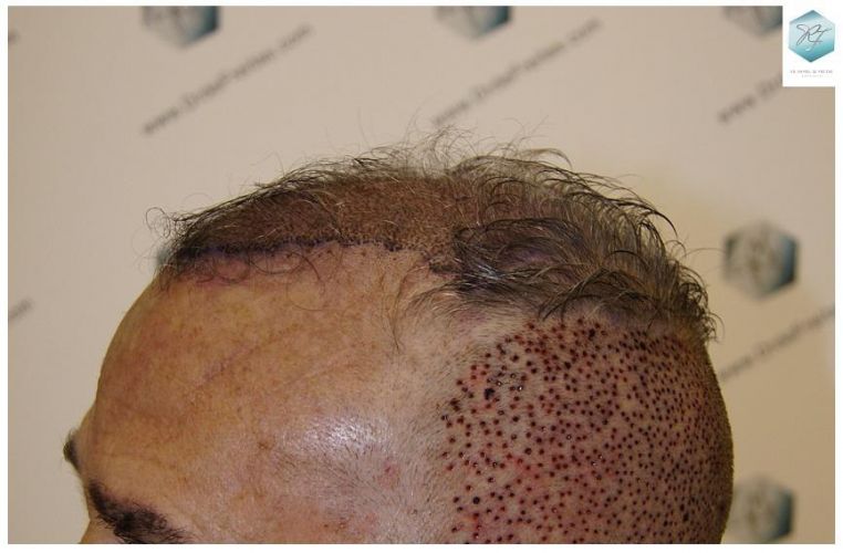 Injerto Capilar Técnica FUE 2911 Grafts (Pelos 6191) 10 trasplante pelo canoso