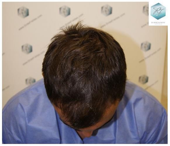 Injerto Capilar Técnica FUE 3129 Grafts (7888 Pelos) 40 recuperar pelo entradas