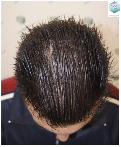 Injerto Capilar Técnica FUE 3129 Grafts (7888 Pelos) 25 recuperar pelo entradas