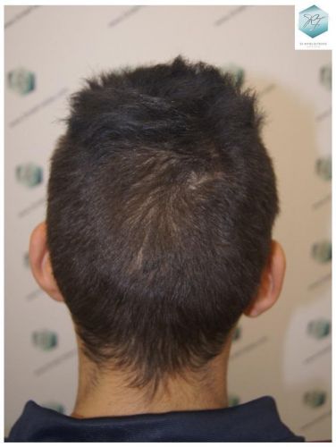 Injerto Capilar Técnica FUE 3129 Grafts (7888 Pelos) 37 INJERTO CAPILAR VALENCIA