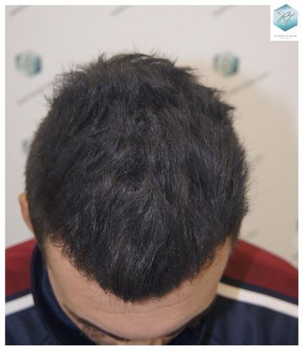 Injerto Capilar Técnica FUE 3129 Grafts (7888 Pelos) 23 INJERTO CAPILAR VALENCIA