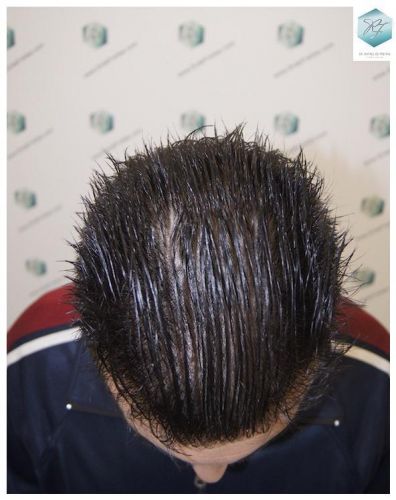 Injerto Capilar Técnica FUE 3129 Grafts (7888 Pelos) 26 INJERTO CAPILAR VALENCIA