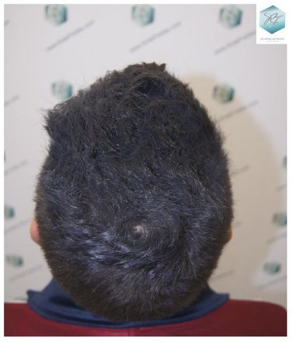 Injerto Capilar Técnica FUE 3129 Grafts (7888 Pelos) 30 INJERTO CAPILAR VALENCIA