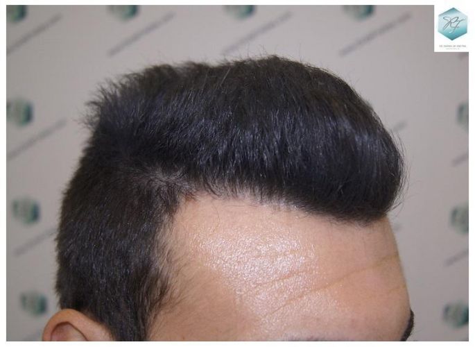 Injerto Capilar Técnica FUE 3129 Grafts (7888 Pelos) 33 INJERTO CAPILAR VALENCIA