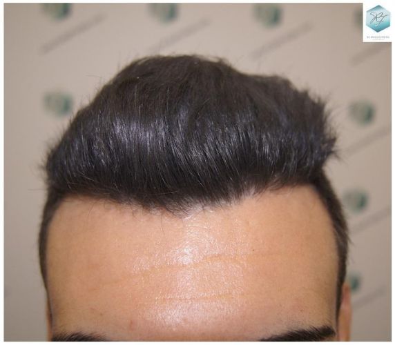 Injerto Capilar Técnica FUE 3129 Grafts (7888 Pelos) 31 INJERTO CAPILAR VALENCIA
