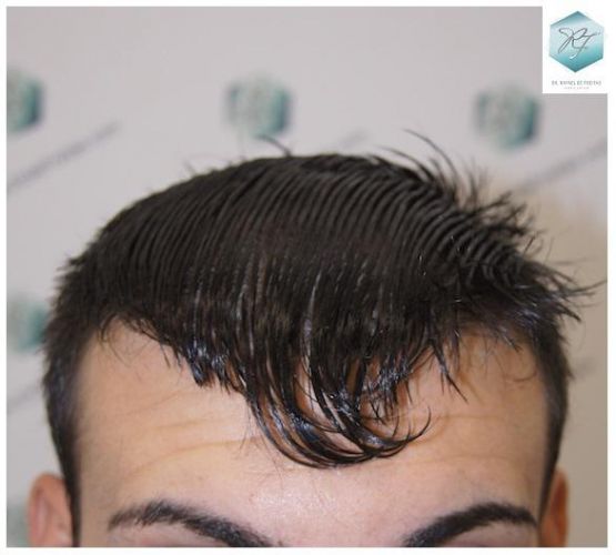 Injerto Capilar Técnica FUE 3129 Grafts (7888 Pelos) 28 INJERTO CAPILAR VALENCIA
