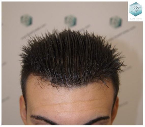Injerto Capilar Técnica FUE 3129 Grafts (7888 Pelos) 24 INJERTO CAPILAR VALENCIA