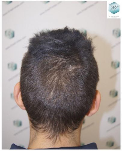 Injerto Capilar Técnica FUE 3129 Grafts (7888 Pelos) 39 INJERTO CAPILAR VALENCIA