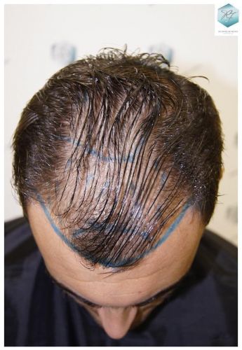 Injerto Capilar Técnica FUE 3129 Grafts (7888 Pelos) 6 recuperar pelo entradas