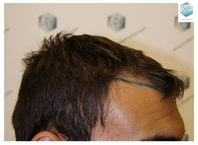 Injerto Capilar Técnica FUE 3129 Grafts (7888 Pelos) 7 recuperar pelo entradas