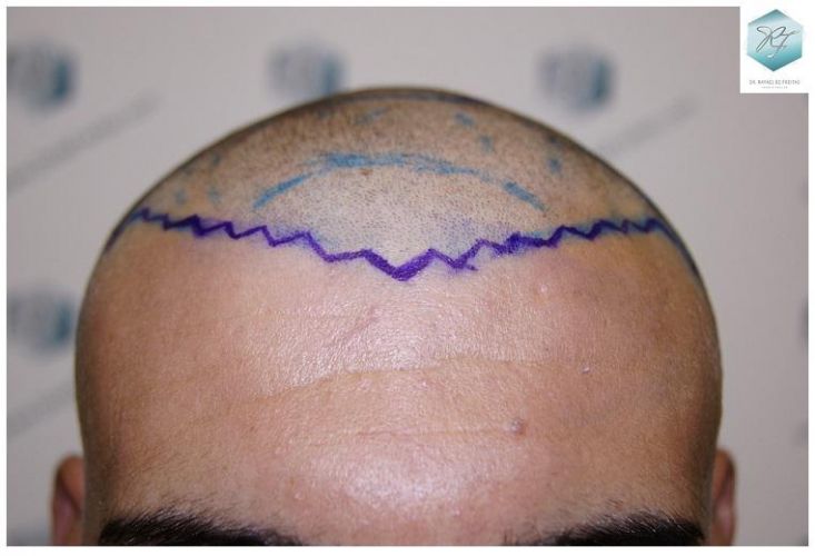 Injerto Capilar Técnica FUE 3129 Grafts (7888 Pelos) 11 recuperar pelo entradas
