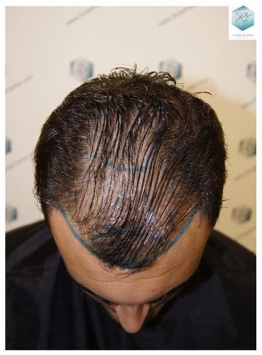 Injerto Capilar Técnica FUE 3129 Grafts (7888 Pelos) 5 recuperar pelo entradas
