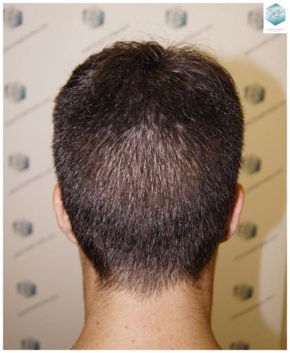 Injerto Capilar Técnica FUE 3129 Grafts (7888 Pelos) 38 INJERTO CAPILAR VALENCIA