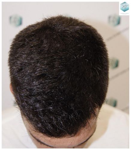 Injerto Capilar Técnica FUE 1804 Grafts (3746 Pelos) 19 INJERTO CAPILAR VALENCIA