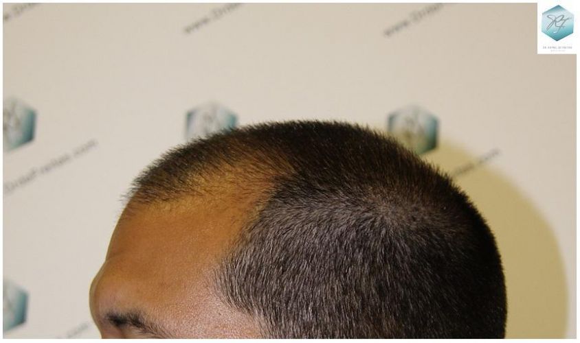 Injerto Capilar Técnica FUE 3217 Grafts (7890 Pelos) 3 INJERTO CAPILAR VALENCIA