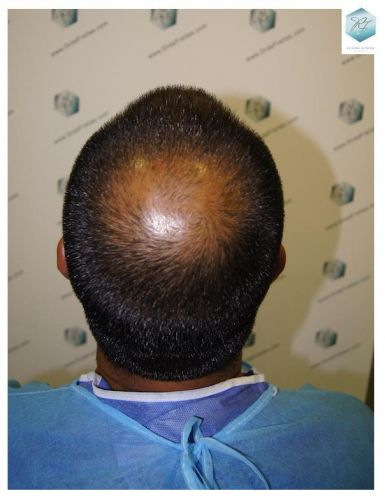 Injerto Capilar Técnica FUE 3217 Grafts (7890 Pelos) 4 INJERTO CAPILAR VALENCIA