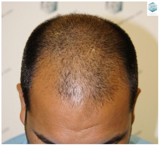 Injerto Capilar Técnica FUE 3217 Grafts (7890 Pelos) 1 INJERTO CAPILAR VALENCIA