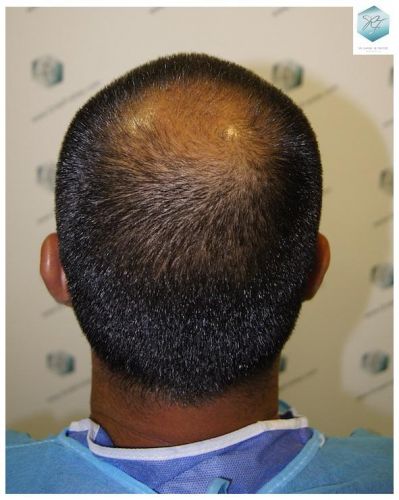 Injerto Capilar Técnica FUE 3217 Grafts (7890 Pelos) 5 INJERTO CAPILAR VALENCIA