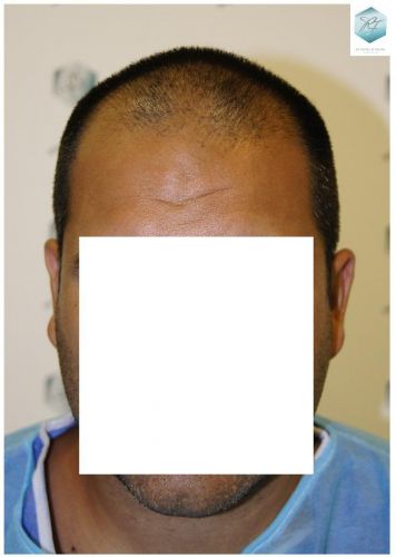 Injerto Capilar Técnica FUE 3217 Grafts (7890 Pelos) 26 INJERTO CAPILAR VALENCIA