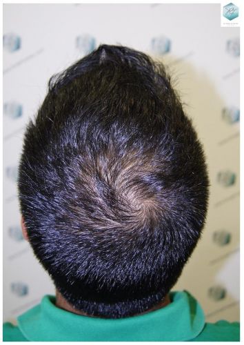 Injerto Capilar Técnica FUE 3217 Grafts (7890 Pelos) 13 TRASPLANTE DE PELO