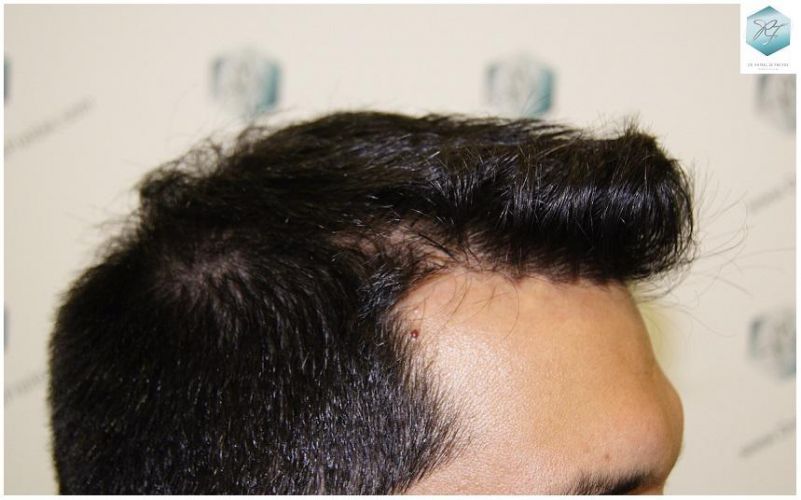 Injerto Capilar Técnica FUE 3217 Grafts (7890 Pelos) 25 TRASPLANTE DE PELO