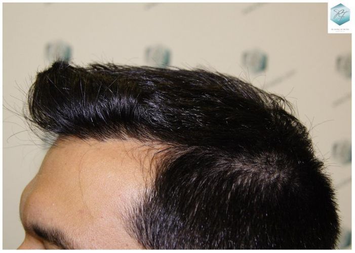 Injerto Capilar Técnica FUE 3217 Grafts (7890 Pelos) 24 TRASPLANTE DE PELO
