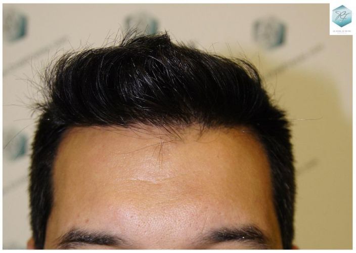 Injerto Capilar Técnica FUE 3217 Grafts (7890 Pelos) 23 TRASPLANTE DE PELO