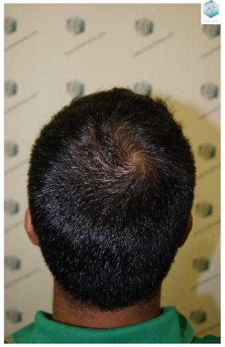Injerto Capilar Técnica FUE 3217 Grafts (7890 Pelos) 12 TRASPLANTE DE PELO