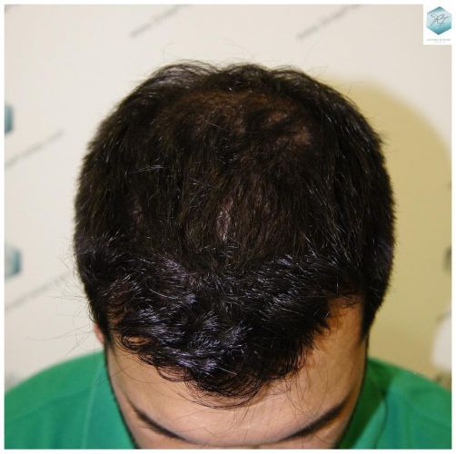 Injerto Capilar Técnica FUE 3217 Grafts (7890 Pelos) 22 TRASPLANTE DE PELO
