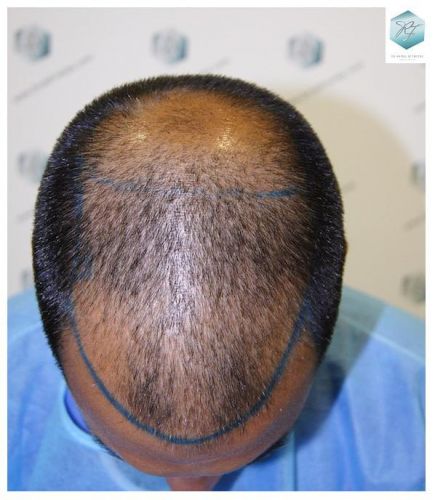 Injerto Capilar Técnica FUE 3217 Grafts (7890 Pelos) 8 TRASPLANTE DE PELO