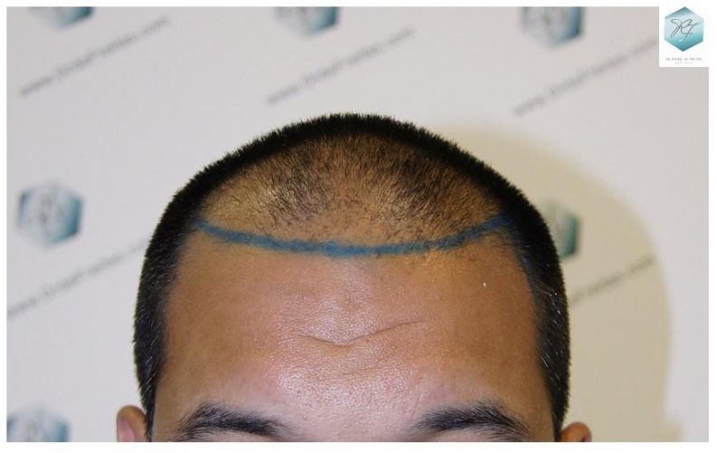 Injerto Capilar Técnica FUE 3217 Grafts (7890 Pelos) 7 TRASPLANTE DE PELO