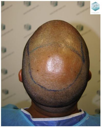 Injerto Capilar Técnica FUE 3217 Grafts (7890 Pelos) 21 TRASPLANTE DE PELO