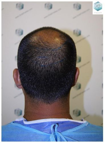 Injerto Capilar Técnica FUE 3217 Grafts (7890 Pelos) 11 TRASPLANTE DE PELO