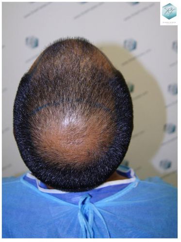 Injerto Capilar Técnica FUE 3217 Grafts (7890 Pelos) 6 TRASPLANTE DE PELO