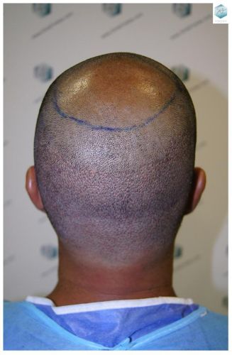 Injerto Capilar Técnica FUE 3217 Grafts (7890 Pelos) 14 TRASPLANTE DE PELO
