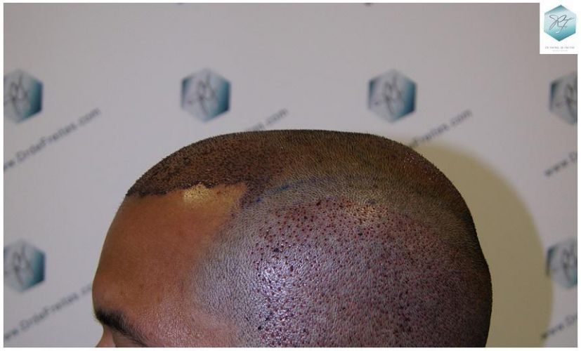 Injerto Capilar Técnica FUE 3217 Grafts (7890 Pelos) 18 TRASPLANTE DE PELO
