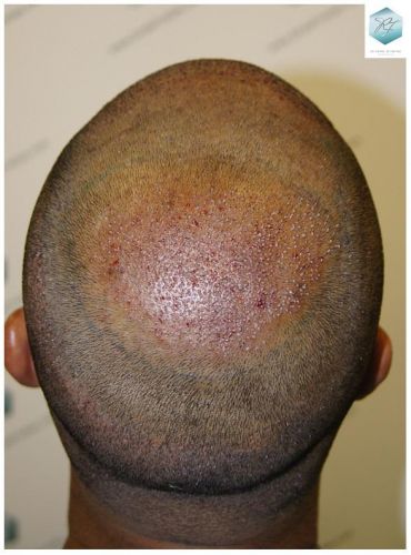 Injerto Capilar Técnica FUE 3217 Grafts (7890 Pelos) 20 TRASPLANTE DE PELO