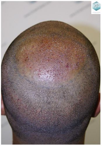 Injerto Capilar Técnica FUE 3217 Grafts (7890 Pelos) 19 TRASPLANTE DE PELO