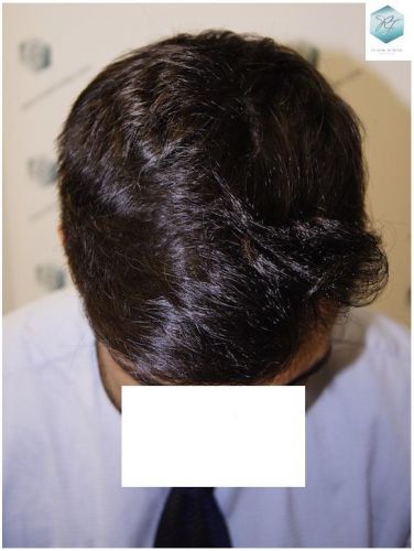 Injerto Capilar Técnica FUE 1870 Grafts (4013 Pelos) 14 TRASPLANTE DE PELO