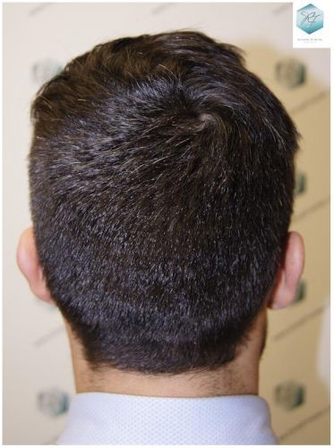 Injerto Capilar Técnica FUE 1870 Grafts (4013 Pelos) 22 TRASPLANTE DE PELO