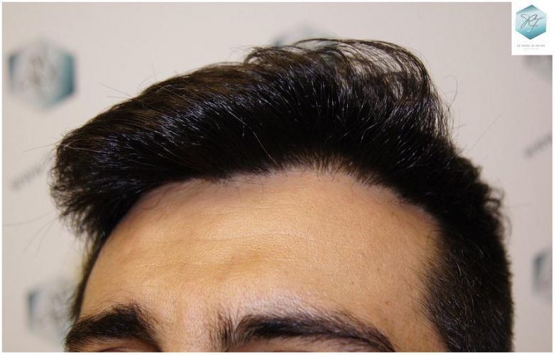 Injerto Capilar Técnica FUE 1870 Grafts (4013 Pelos) 17 TRASPLANTE DE PELO