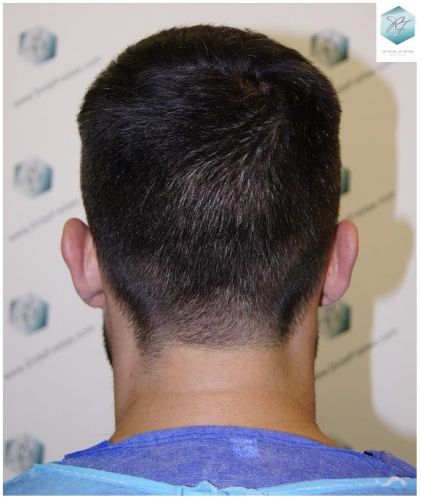 Injerto Capilar Técnica FUE 1870 Grafts (4013 Pelos) 21 TRASPLANTE DE PELO