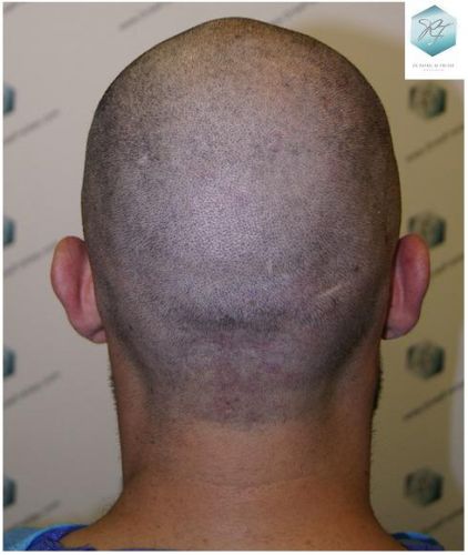 Injerto Capilar Técnica FUE 1870 Grafts (4013 Pelos) 13 TRASPLANTE DE PELO